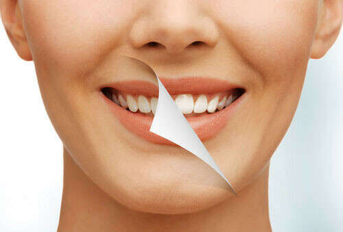 Процедура ультразвуковой чистки зубов