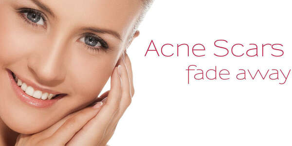 Get Acne Scar Removal Treatment in Huntington Beach