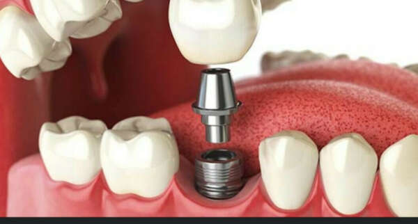 имплант 1 зуб