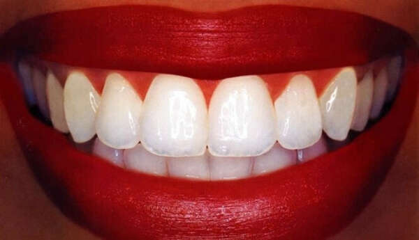 Восстановить зубы до идеального состояния